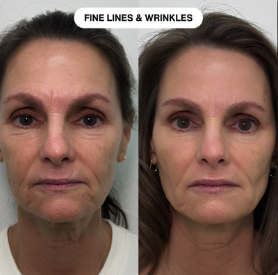Nelival™ Line Filler Primer